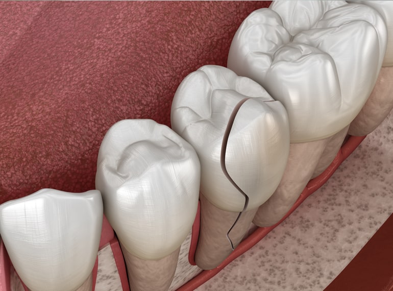 Chipped teeth, Dental Crack Diagnosis