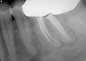 distal root canal after procedure