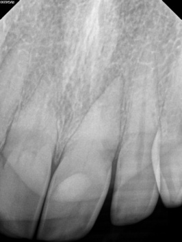 narrow root canal before procedure 