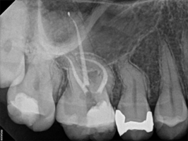 curved root canal after procedure