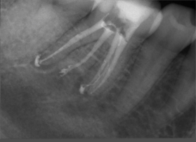 accessory canal after procedure