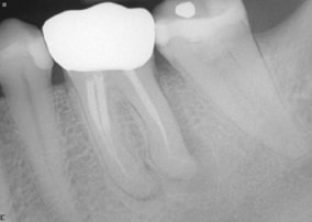 distal root canal before procedure
