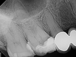 Mesio-Buccal root canal before procedure
