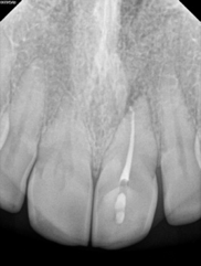 root canal after procedure
