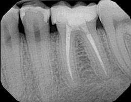 Multiple Root Canals