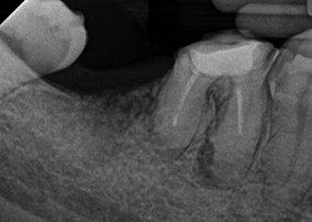 root canal re-treatment