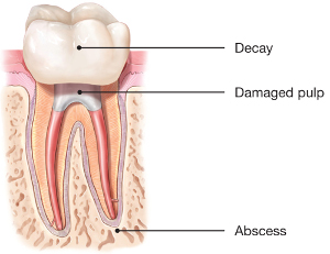An infected root canal due to decay leads to infection at the root ends (abscess)